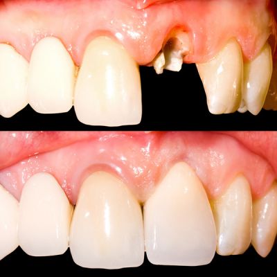 Implant