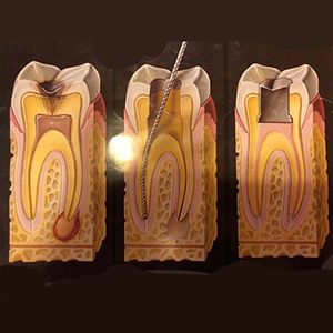 Root Canals